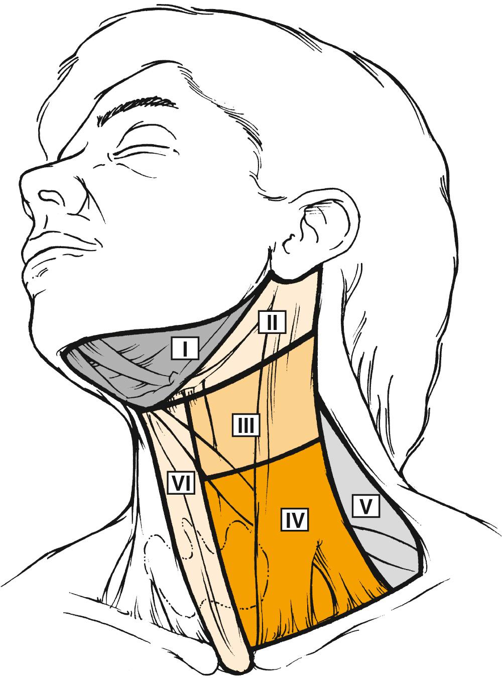 Fig. 105.8, The six nodal levels of the neck.