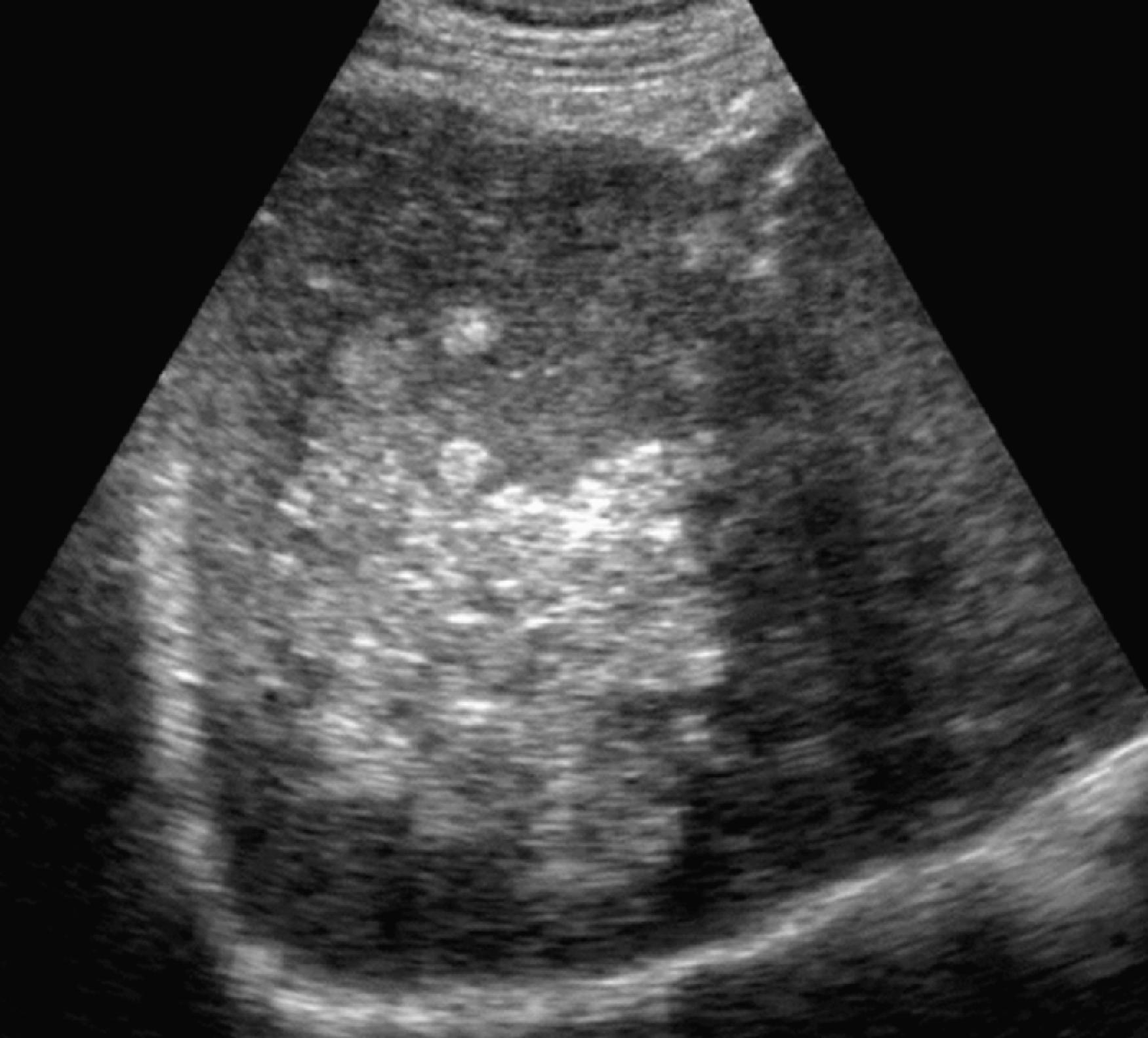 Fig. 54.1, Hepatocellular carcinoma: sonographic features.