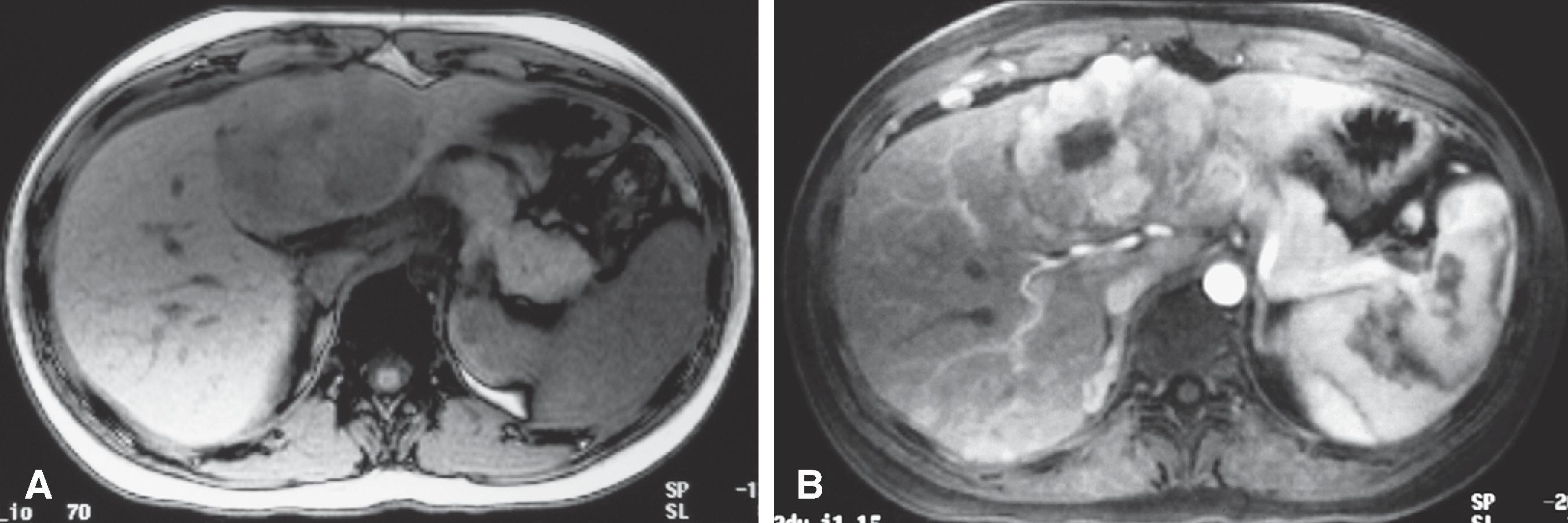 Fig. 54.11, Fibrolamellar carcinoma: magnetic resonance imaging findings.