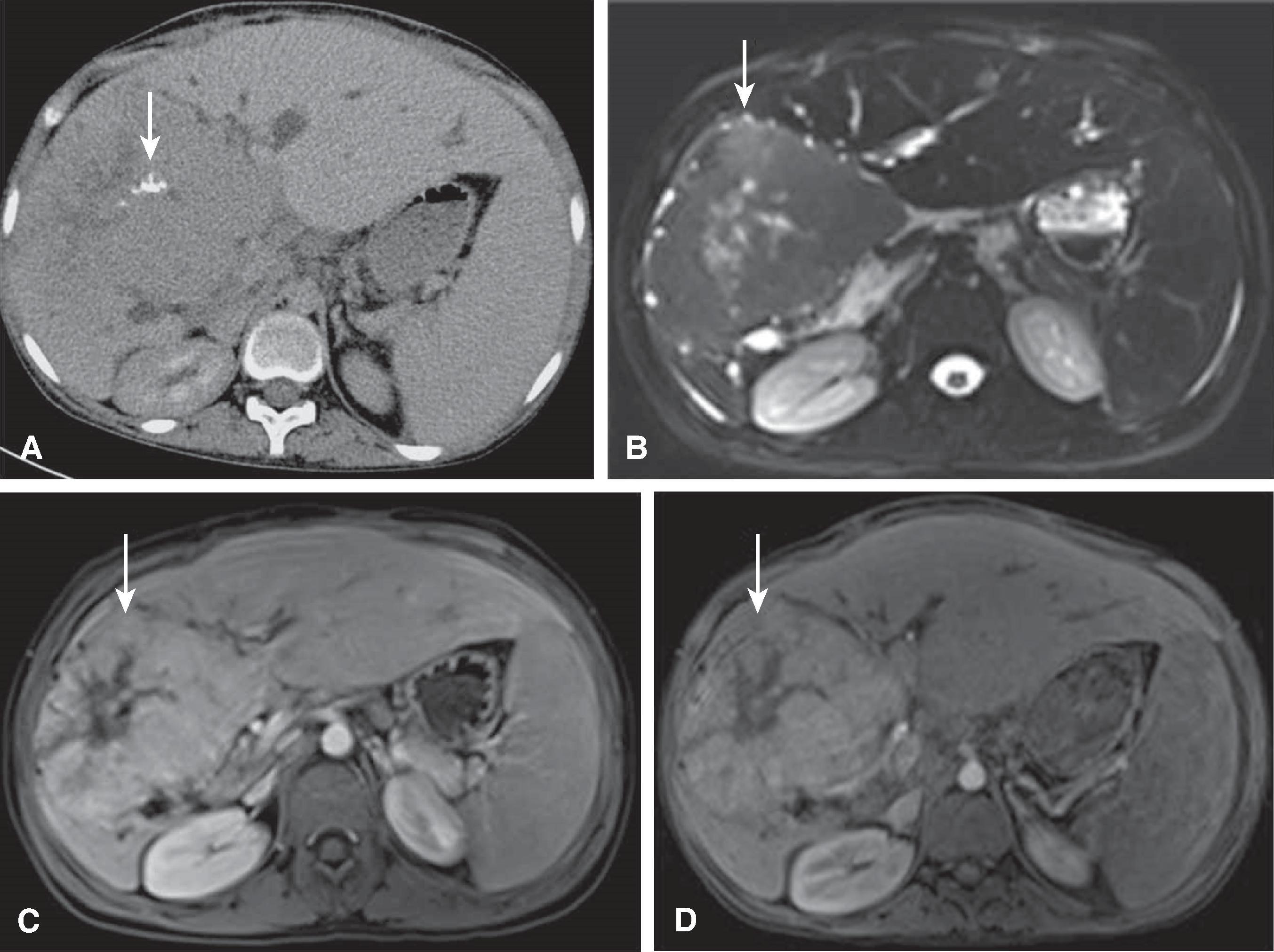 Fig. 54.12, Fibrolamellar carcinoma: computed tomography (CT) and magnetic resonance imaging findings.