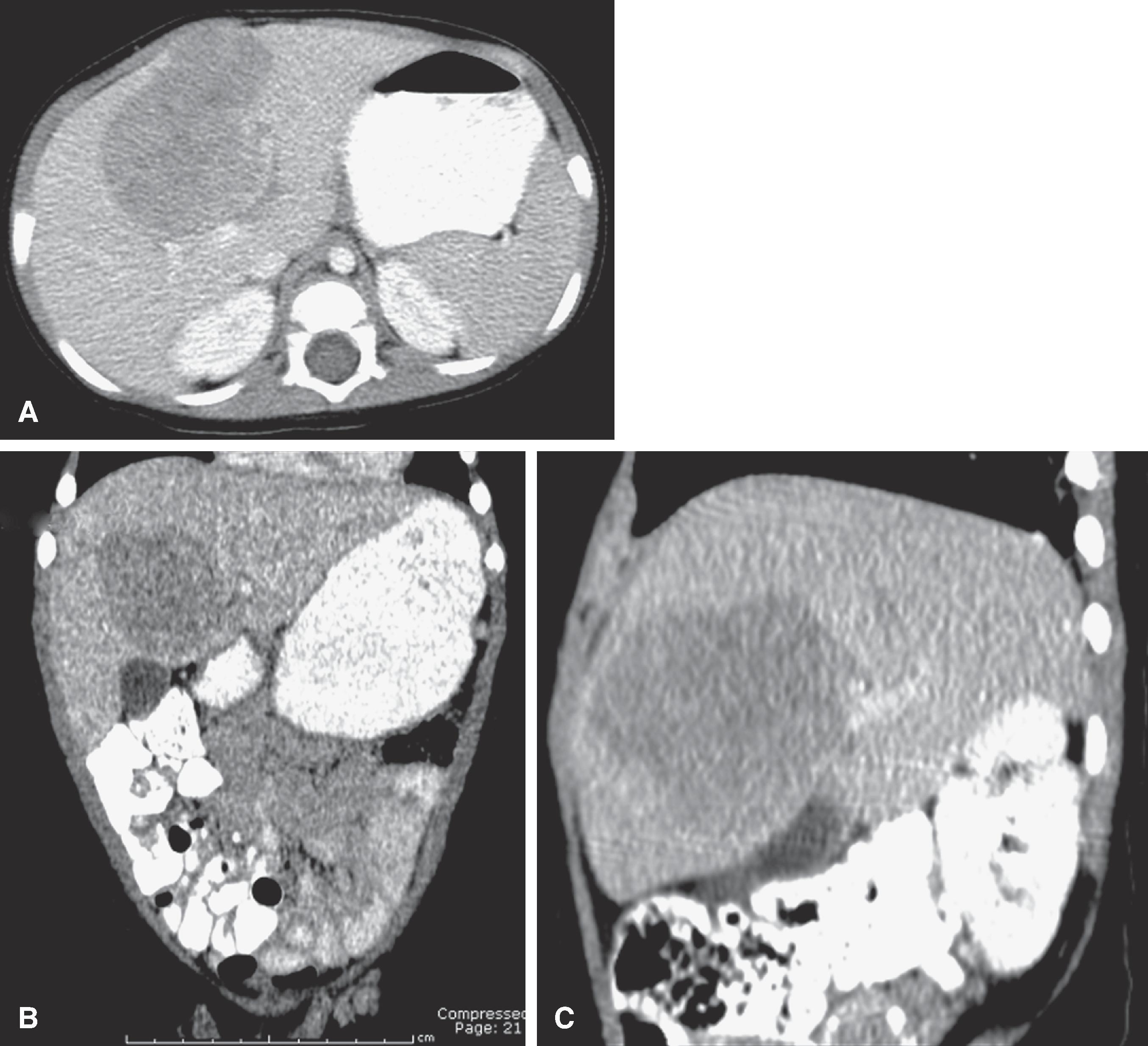 Fig. 54.13, Hepatoblastoma: imaging features.