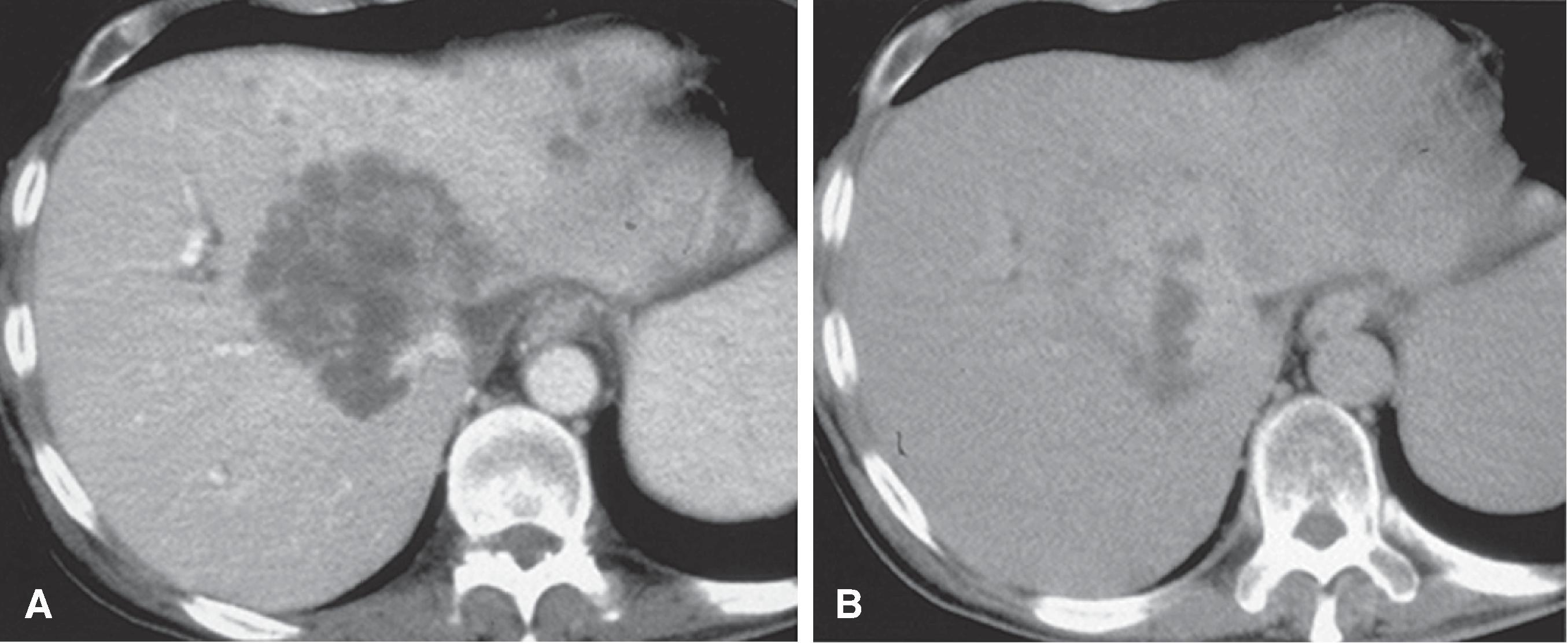 Fig. 54.14, Intrahepatic cholangiocarcinoma: computed tomography features.