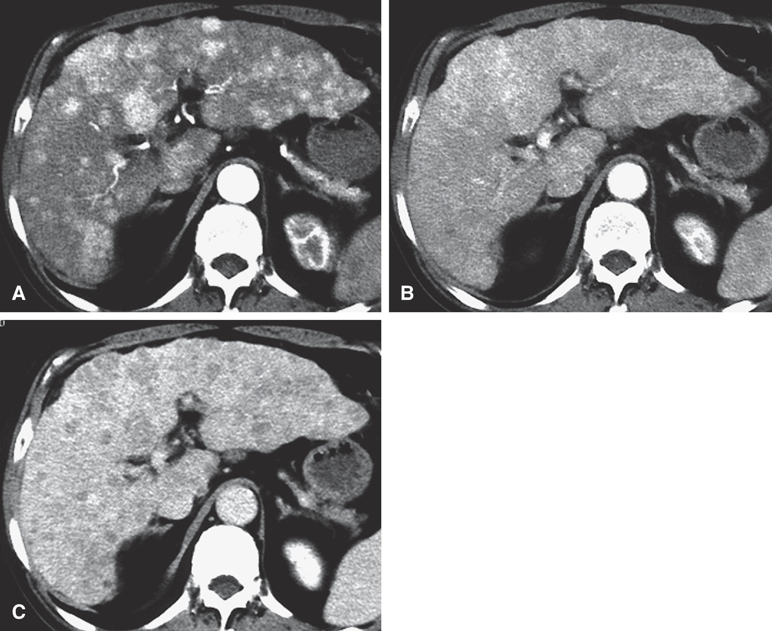 Fig. 54.2, Hepatocellular carcinoma (HCC): computed tomography (CT) appearance.