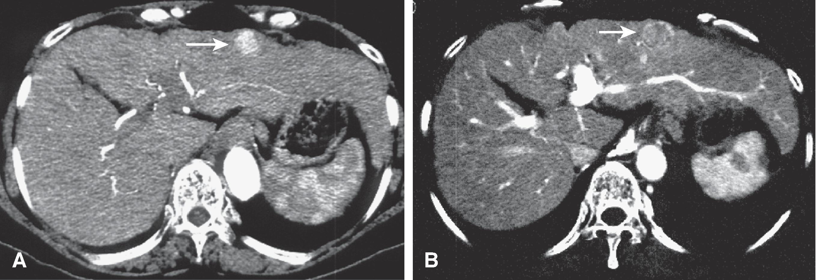Fig. 54.3, Hepatocellular carcinoma (HCC): computed tomography (CT) findings.