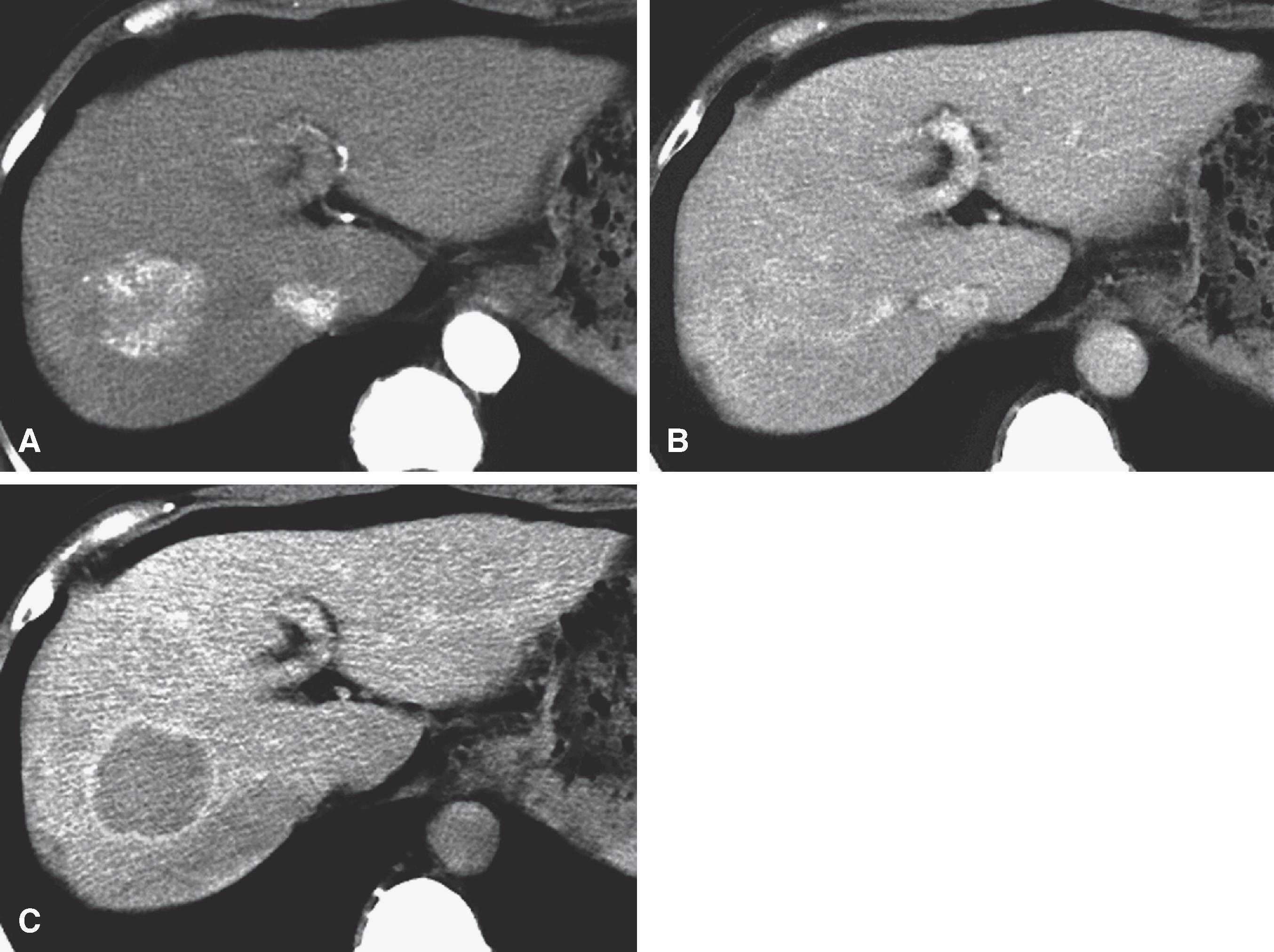 Fig. 54.4, Hepatocellular carcinoma: computed tomography (CT) features.