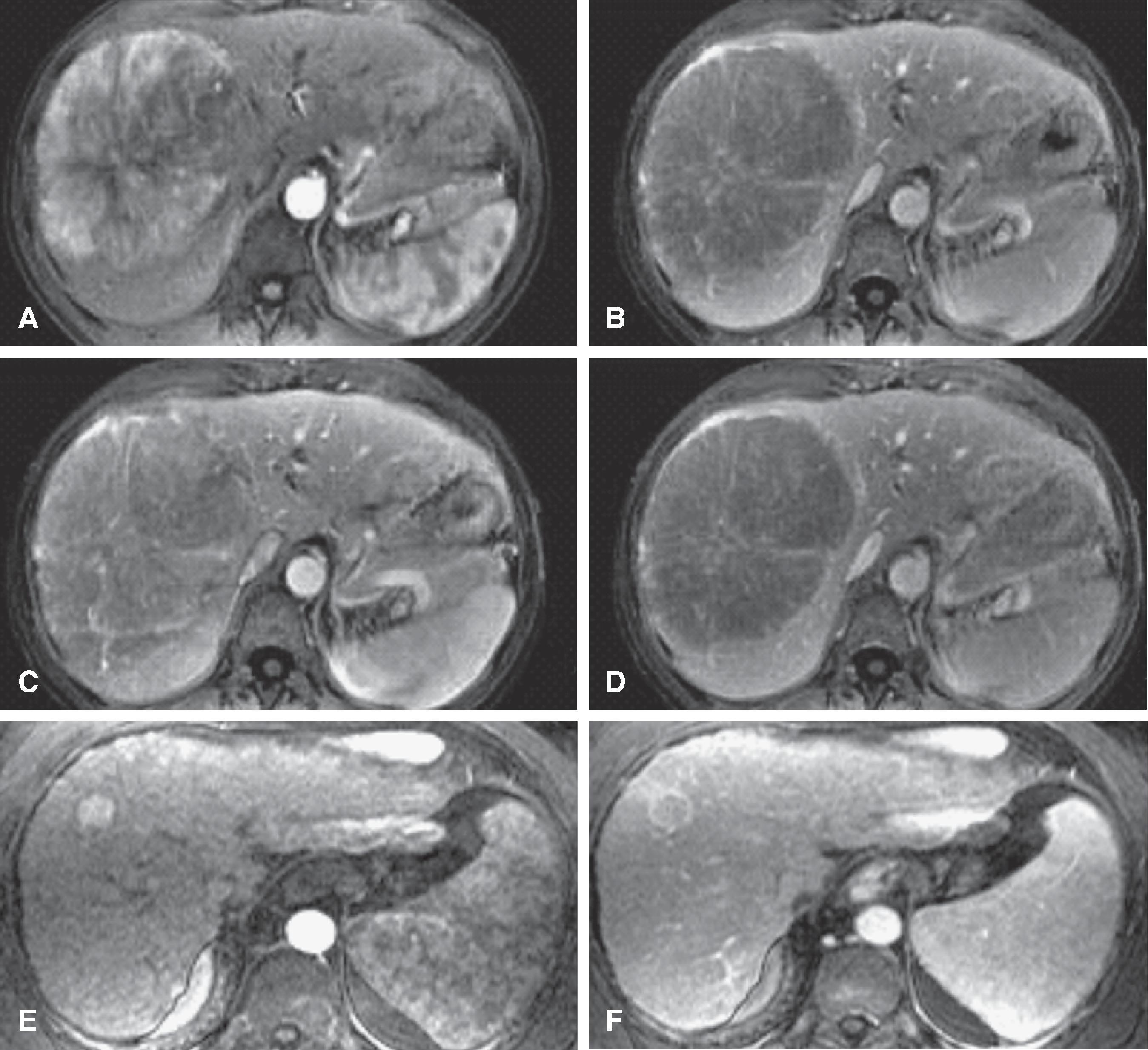 Fig. 54.5, Hepatocellular carcinoma (HCC): magnetic resonance imaging contrast enhancement patterns.