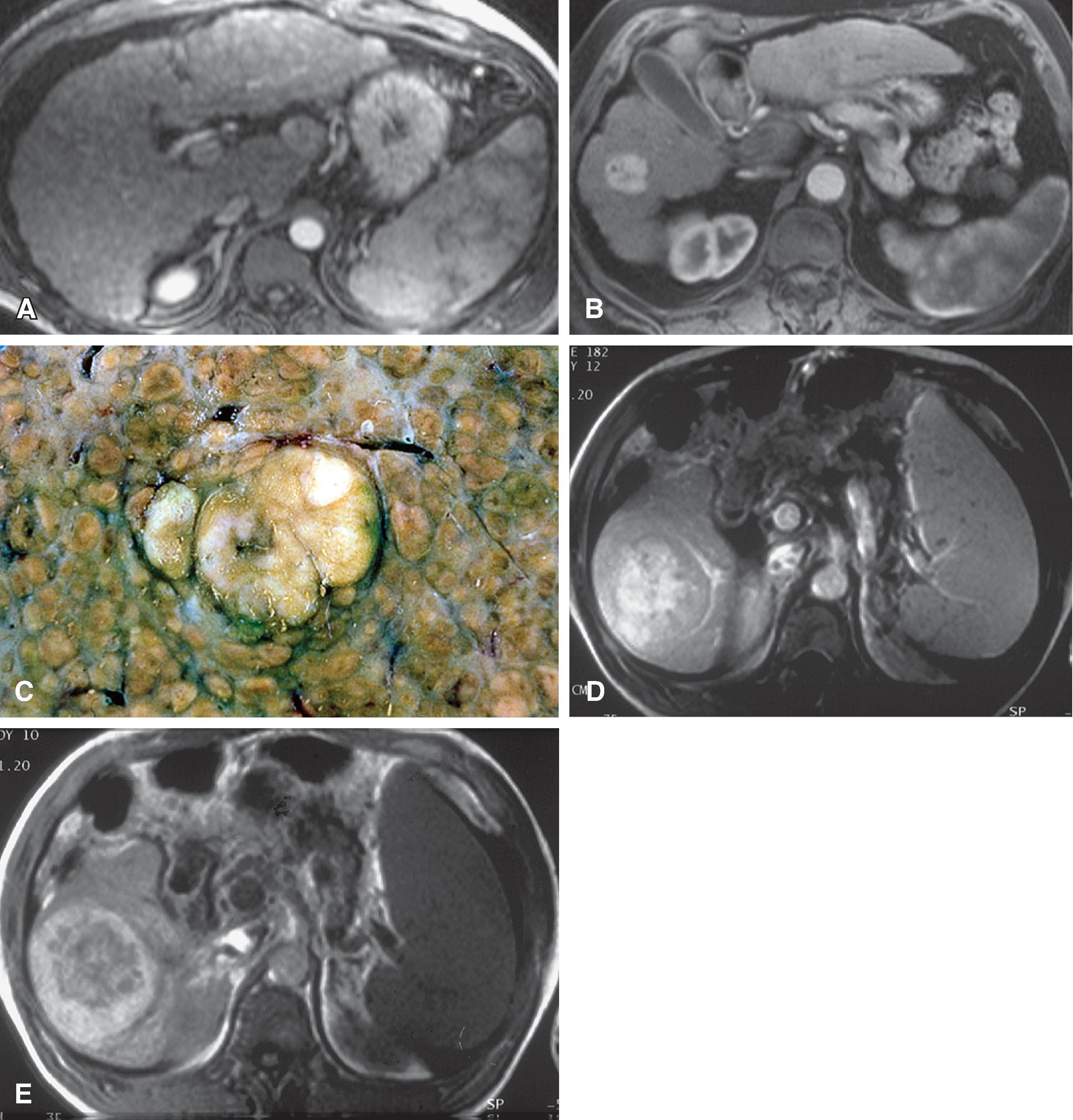 Fig. 54.6, Hepatocellular carcinoma (HCC): magnetic resonance imaging appearances.