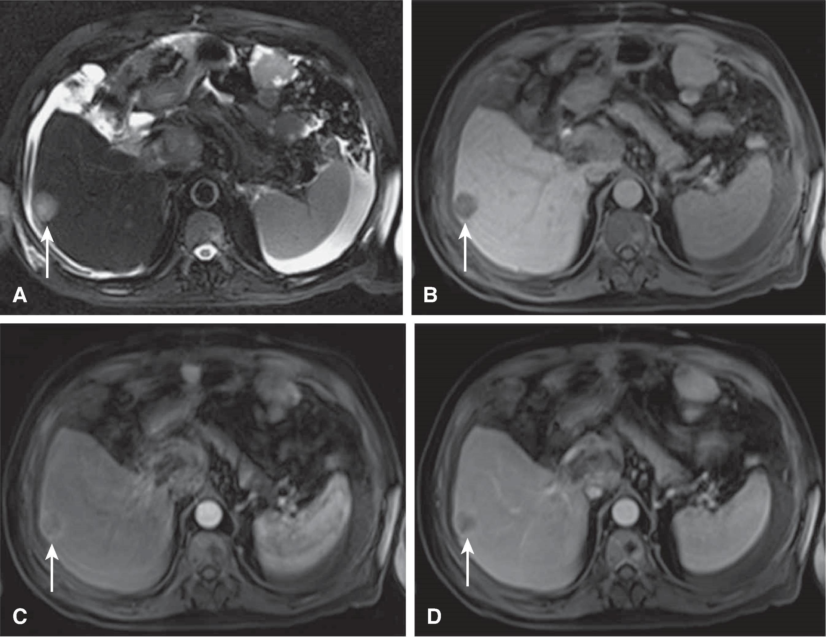 Fig. 54.7, Hepatocellular carcinoma (HCC): magnetic resonance imaging findings.