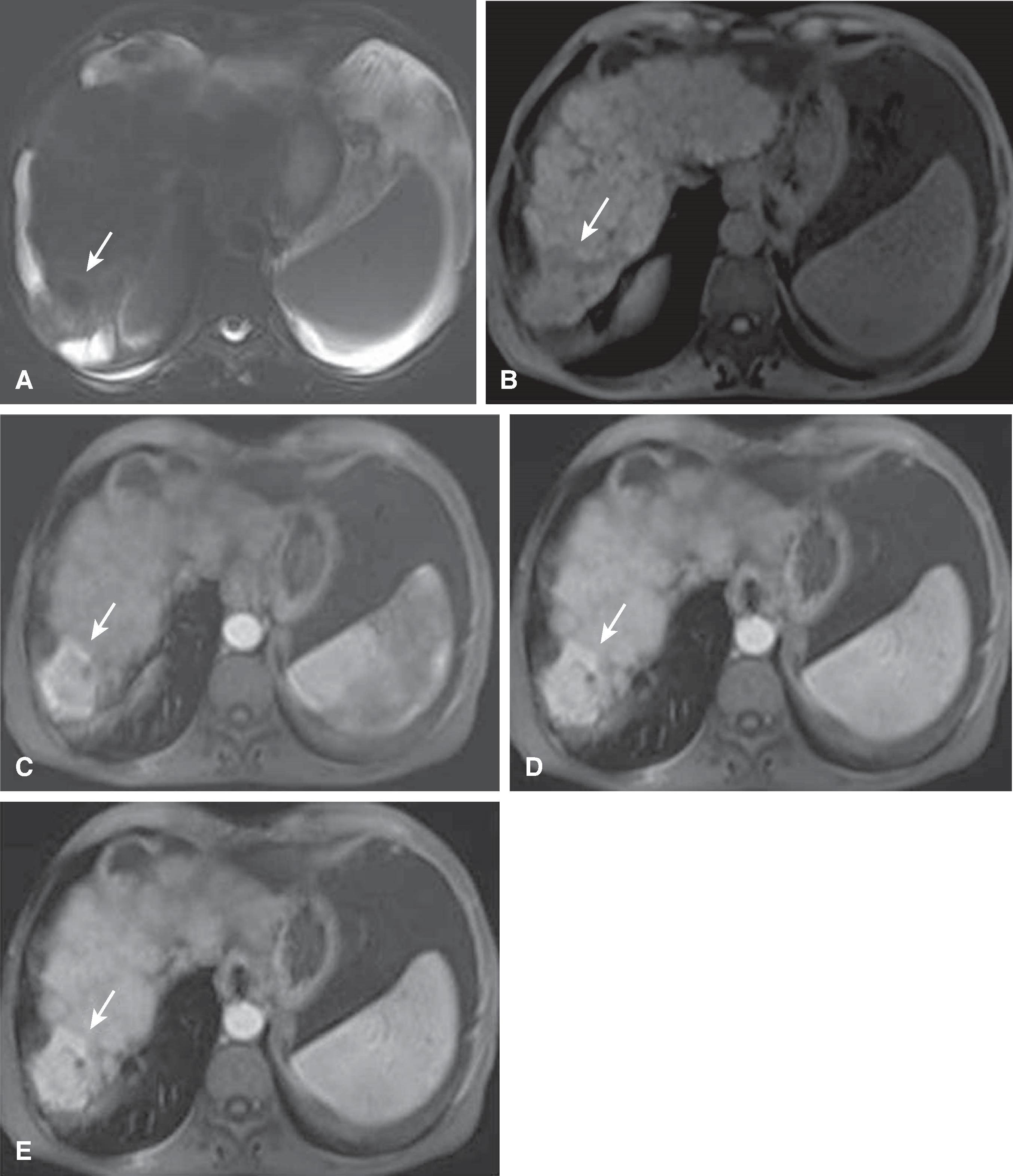 Fig. 54.8, Hepatocellular carcinoma (HCC): magnetic resonance imaging findings.