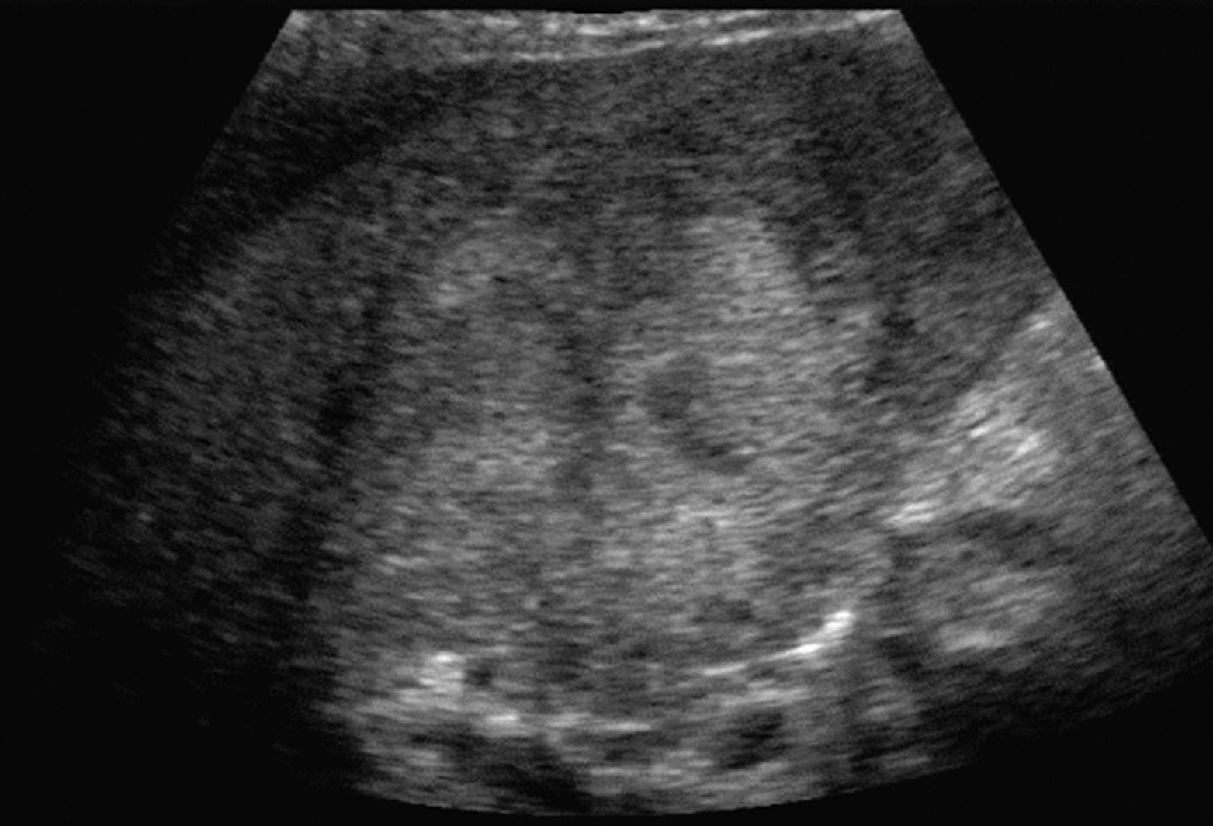 Fig. 54.9, Fibrolamellar carcinoma: ultrasound findings.