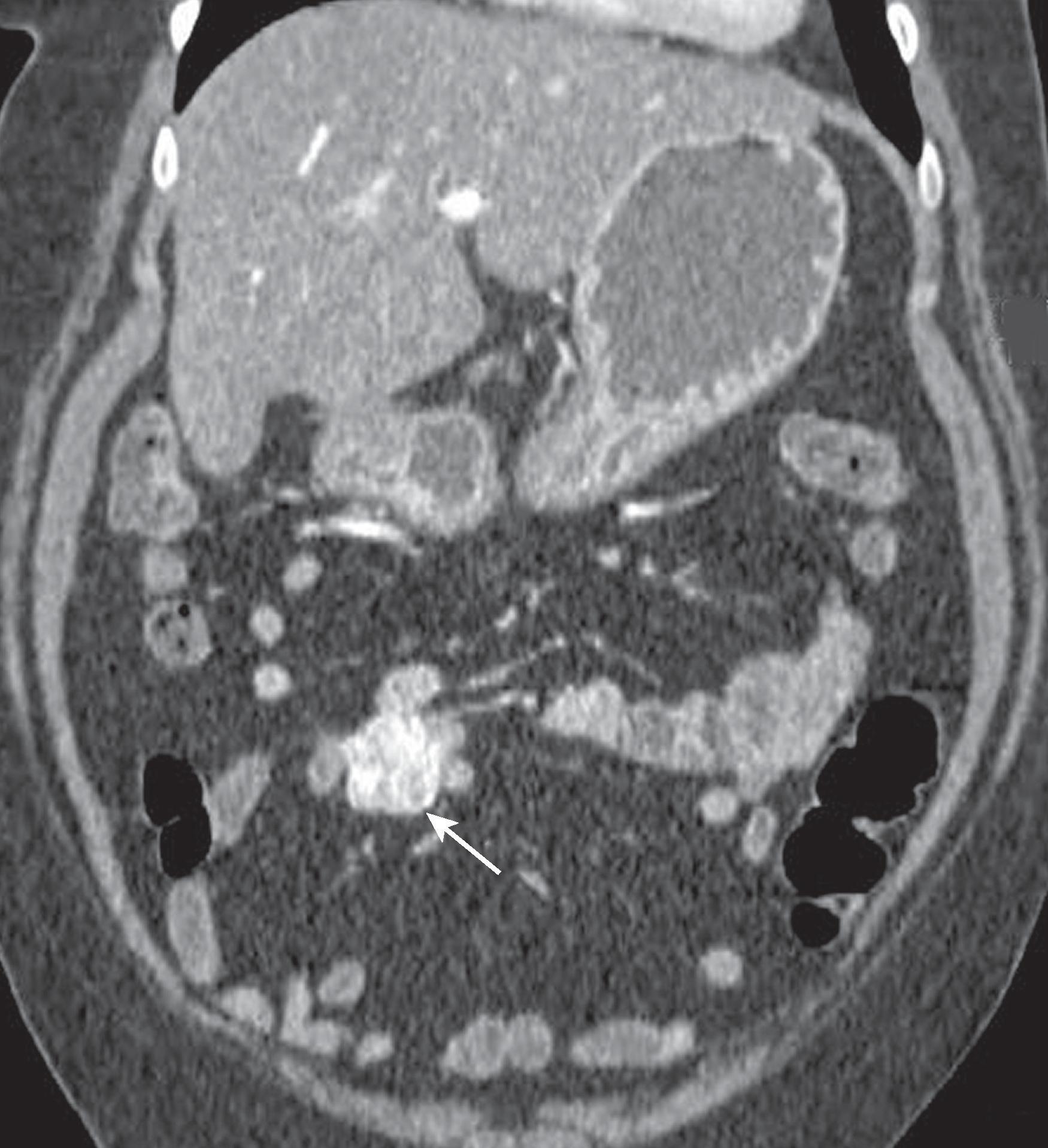 Fig. 31.1, Typical findings of gastrointestinal stromal tumor.