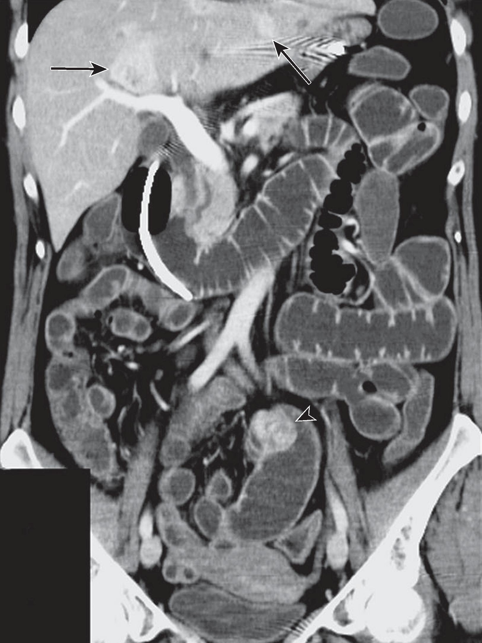 Fig. 31.2, Metastatic small bowel neuroendocrine tumor.