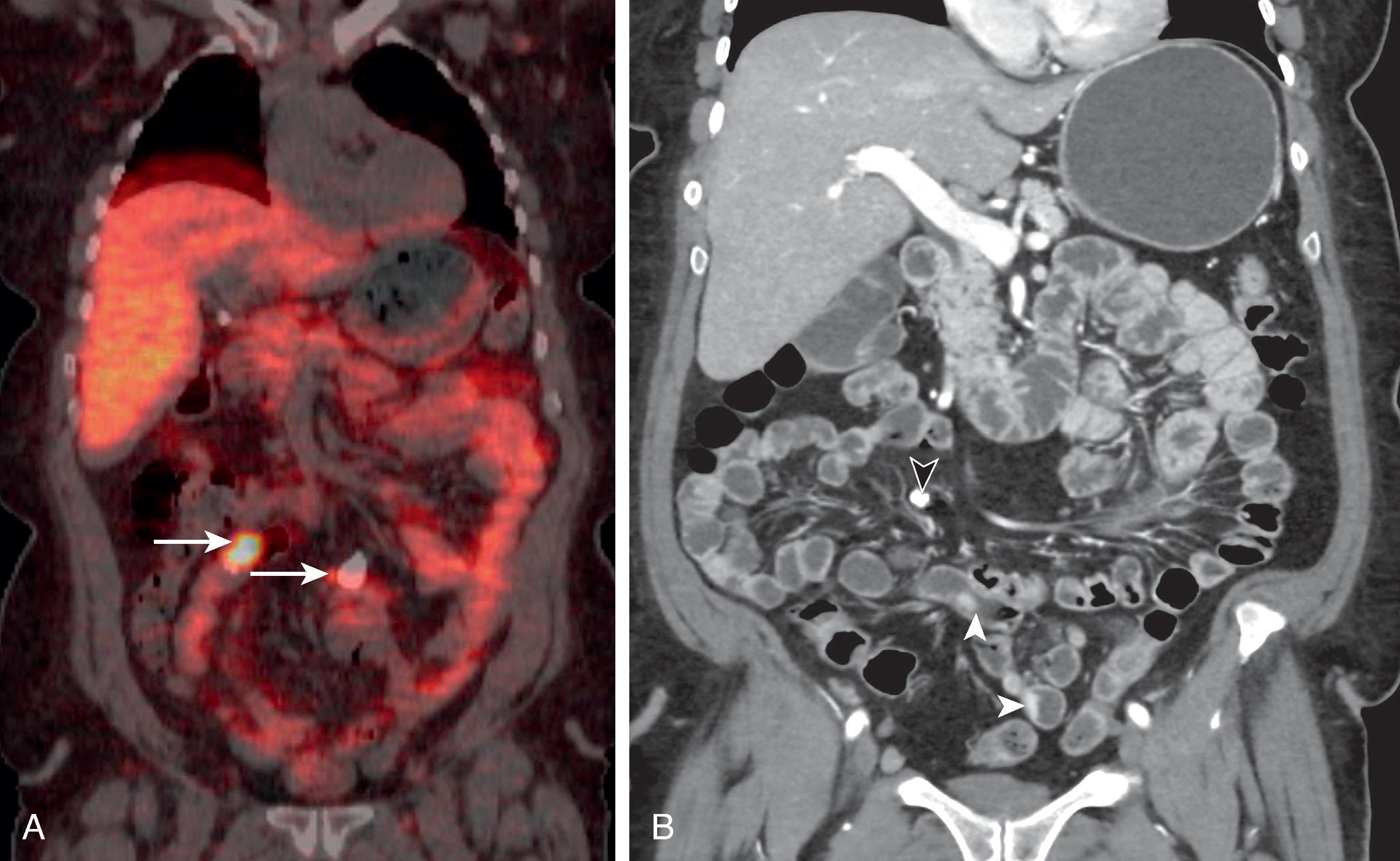 Fig. 31.3, Neuroendocrine tumor of unknown primary site in a 68-year-old woman.