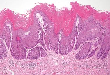 Fig. 2.1, High-grade intraepithelial lesion (VIN 2–3), warty type. Prominent hyperkeratosis with surface papillarity and focal koilocytosis is seen.