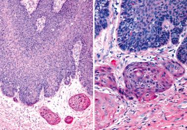 Fig. 2.18, Squamous cell carcinoma with superficial invasion. Left: Small nests of invasive tumor lie within a loose reactive stroma. Right: The invasive nests at the bottom of the field show greater maturation than the overlying VIN.