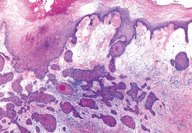 Fig. 2.19, Invasive squamous cell carcinoma associated with lichen sclerosus (top right).