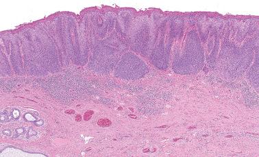 Fig. 2.2, High-grade squamous intraepithelial lesion (VIN 3), basaloid type. A flat lesion with keratosis is composed of cells with scant cytoplasm resulting in a basaloid appearance.