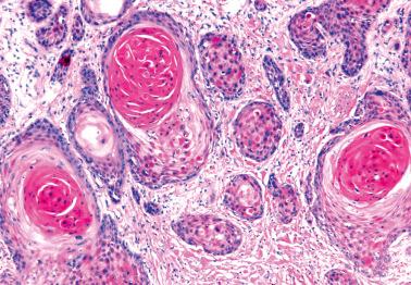 Fig. 2.21, Invasive keratinizing squamous cell carcinoma.