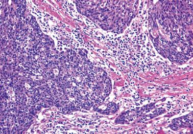 Fig. 2.22, Invasive squamous cell carcinoma, basaloid type.