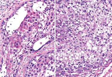 Fig. 2.23, Two uncommon findings in vulvar squamous cell carcinomas: acantholysis resulting in gland-like spaces (left) and cells with clear (glycogen-rich) cytoplasm (right).