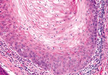 Fig. 2.25, Verrucous carcinoma. Note the bland nuclear features.