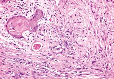 Fig. 2.26, Sarcomatoid squamous cell carcinoma. Most of the tumor cells are spindle-shaped and lie within a fibrotic stroma. A nest of typical squamous cell carcinoma is also present (upper left).