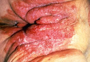 Fig. 2.27, Paget's disease with extensive involvement of the vulva.