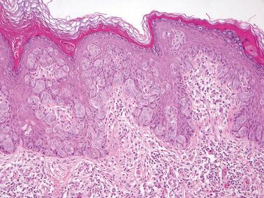 Fig. 2.28, Paget's disease. Nests and individual cells with abundant pale amphophilic cytoplasm are predominantly basal in distribution.