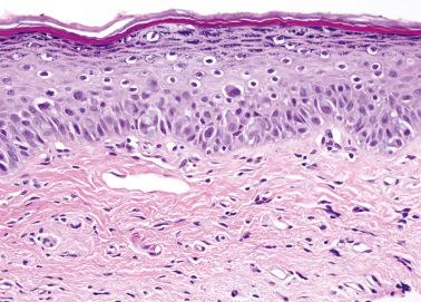 Fig. 2.29, Paget's disease. In some cases, the atypical cells are sparsely distributed and can potentially be overlooked.