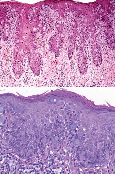 Fig. 2.30, Paget's disease. The atypical cells may extend into the more superficial epidermis (top). Scattered cells contain cytoplasmic vacuoles (top), which can be more basophilic in appearance (bottom). These cells would highlight with special stains, such as mucicarmine.