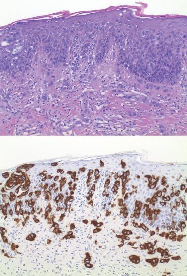 Fig. 2.31, Paget's disease with superficial invasion, H&E and CK7 immunostain. The tumor cells are seen in the epidermis and superficial dermis (top). CK7 intensely highlights the neoplastic cells in contrast to the negatively staining keratinocytes in the epidermis (bottom).