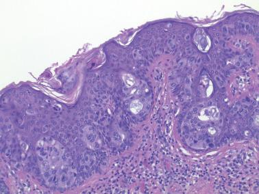 Fig. 2.32, Paget's disease. Rarely gland formation may be seen.