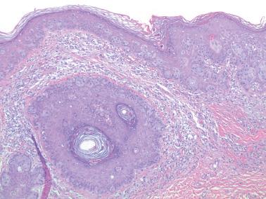 Fig. 2.33, Paget's disease with adnexal involvement.