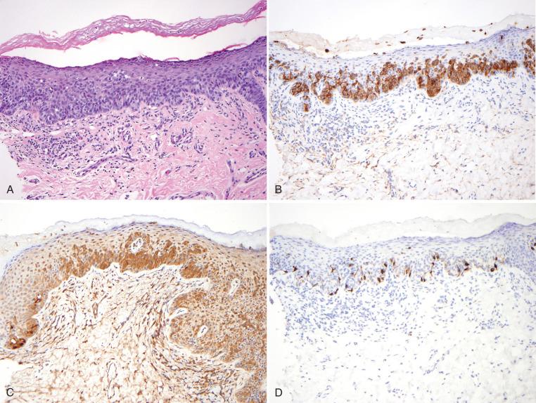 Fig. 2.34, Paget's disease, H&E (a) and additional staining patterns (b–d). The atypical cells in Paget's disease are positive for CK7 (see Fig. 2.31 ), EMA (b) and GCDFP-15 (c). The neoplastic cells are negative for melan-A (d), but background melanocytes will be positive.