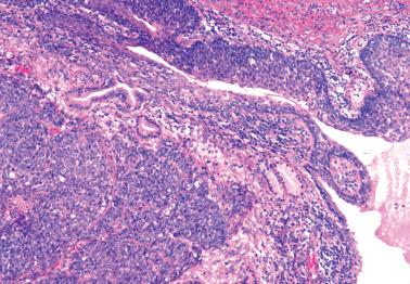 Fig. 2.35, In situ and invasive squamous cell carcinoma of Bartholin's gland. The Bartholin's duct (lumen, lower right) is lined focally by squamous cell carcinoma in situ (top center and top right). Invasive squamous cell carcinoma is present in the lower left. Note residual Bartholin's gland acini.