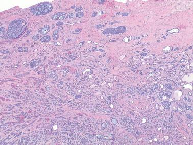 Fig. 2.36, Adenoid cystic carcinoma of Bartholin's gland. Widely infiltrative lesion with characteristic scattered cribriform pattern.