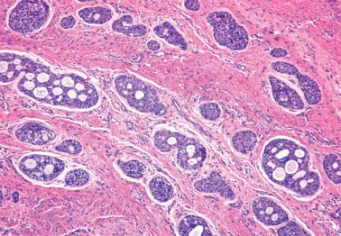 Fig. 2.37, Adenoid cystic carcinoma of Bartholin's gland.