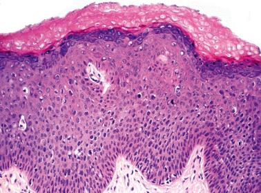 Fig. 2.4, High-grade squamous intraepithelial lesion (VIN 2), usual type. Cytologic atypia is largely confined to the lower two-thirds of the epithelium.