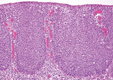 Fig. 2.5, High-grade squamous intraepithelial lesion (VIN 3), basaloid type. Full-thickness cytologic atypia and brisk mitotic activity are seen.