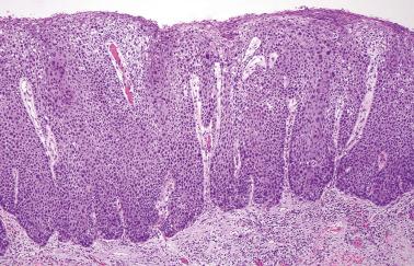 Fig. 2.6, High-grade squamous intraepithelial lesion (VIN 3). This example shows more pleomorphism than the previous illustration.