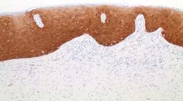 Fig. 2.9, High-grade squamous intraepithelial lesion (VIN 3) demonstrates diffuse block positivity of p16.