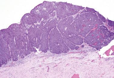 Fig. 2.10, High-grade squamous intraepithelial lesion (VIN 3). Expansion of the rete ridges and tangential sectioning (as seen here) may lead to the misdiagnosis of invasion.