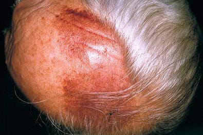 Fig. 22.1, Angiosarcoma of scalp in elderly man.