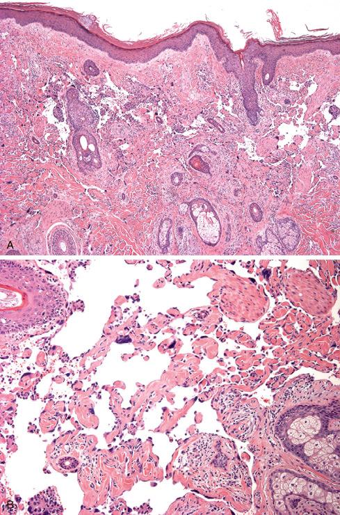 Fig. 22.3, Cutaneous angiosarcoma composed of irregular vascular channels ( A ) infiltrating the dermis ( B ) and lined by atypical cells, which dissect collagen ( C ) and fat ( D ).