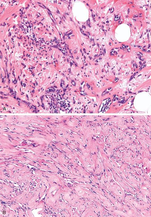 Fig. 22.6, Patterns within angiosarcoma ranging from well-formed vessels ( A ), spindled slitlike vessels ( B-D ), solid areas ( E and F ), and sievelike areas ( G ).