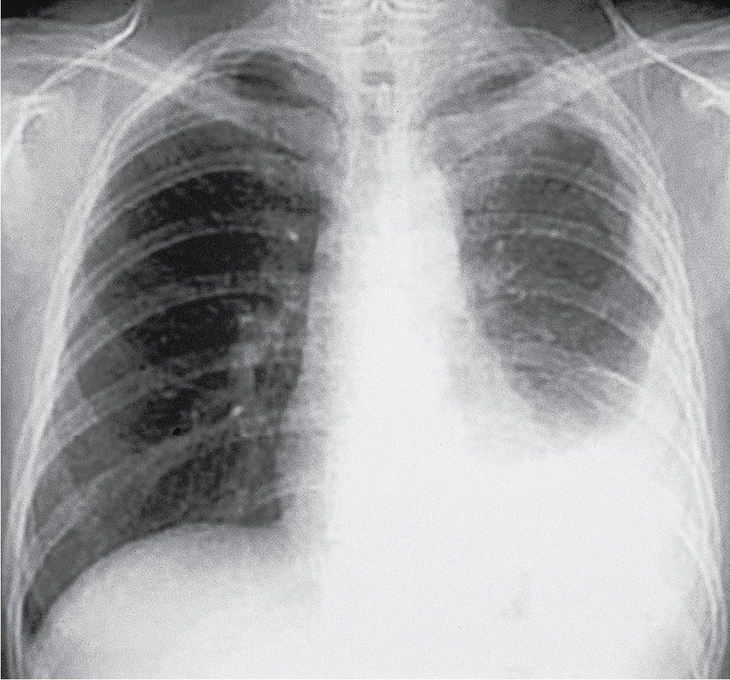 Figure 21.1, Chest radiograph from a patient with malignant pleural mesothelioma demonstrating a large left pleural effusion.