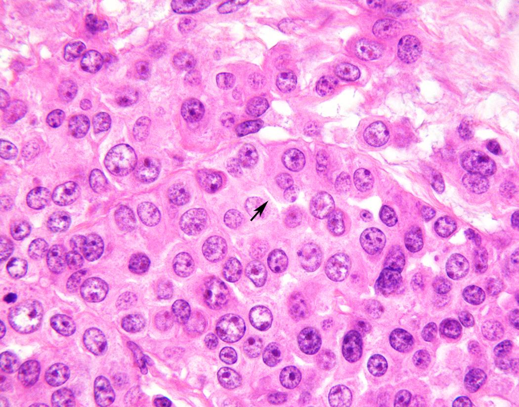 Figure 21.11, Epithelioid mesothelioma. Nuclei are round to ovoid, with smooth borders and small nucleoli; occasional “skirts” or “windows” between cells representing microvilli may be seen (arrow) (H&E, 100×).