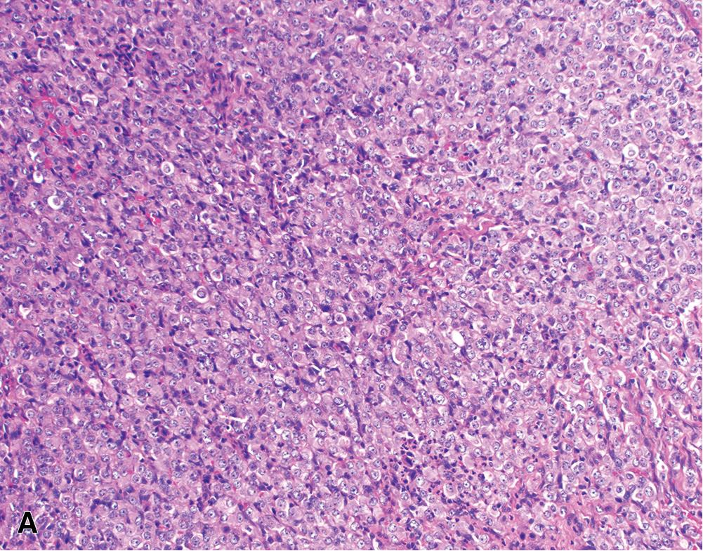 Figure 21.12, Epithelioid mesothelioma: (A) solid pattern (200×); (B) trabecular architecture (200×); (C) micropapillary pattern, characterized by small clusters of epithelioid cells without true fibrovascular cores. (H&E, 400×).