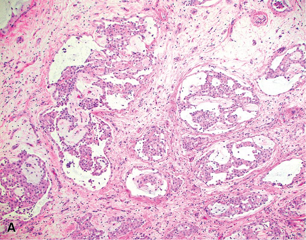 Figure 21.13, Epithelioid mesothelioma, tubulopapillary architecture (A) characterized by true papillae with fibrovascular cores, projecting into tubular spaces lined by a single tumor cell layer; (B) with exuberant stromal proliferation; (C) with psammomatous calcifications (H&E, 400×).