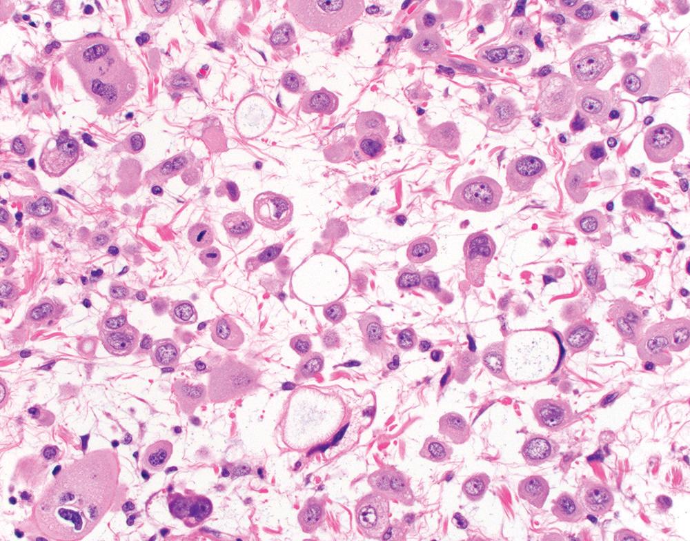 Figure 21.14, Epithelioid mesothelioma with signet ring features. Note scattered cells with compressed, eccentrically displaced nuclei and a single large intracytoplasmic hyaluronic acid droplet, which may cause diagnostic confusion with signet ring cell carcinoma. The tumor stroma also contains abundant secreted hyaluronic acid (H&E, 400×).